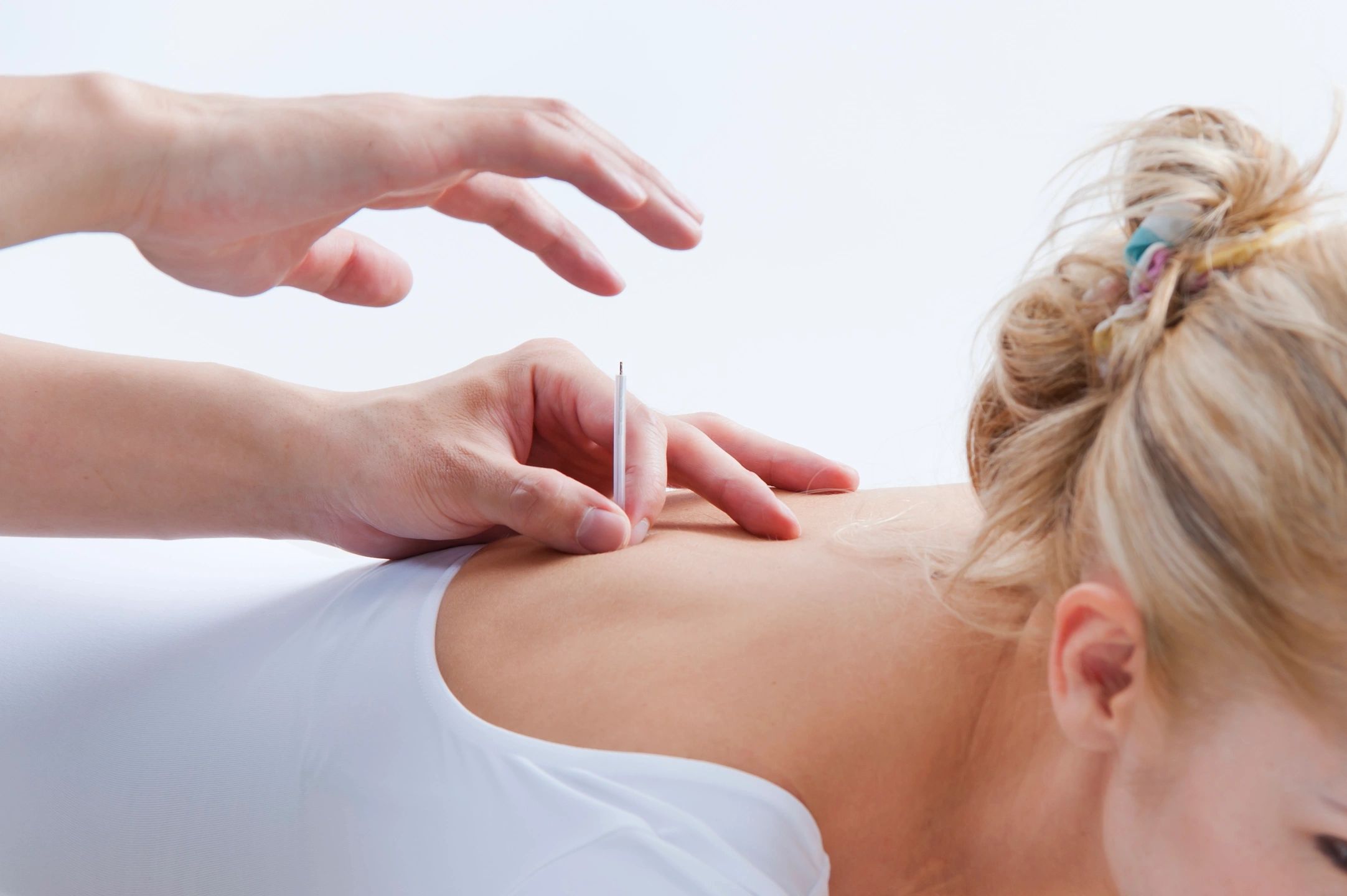 Picture of acupuncture treatment